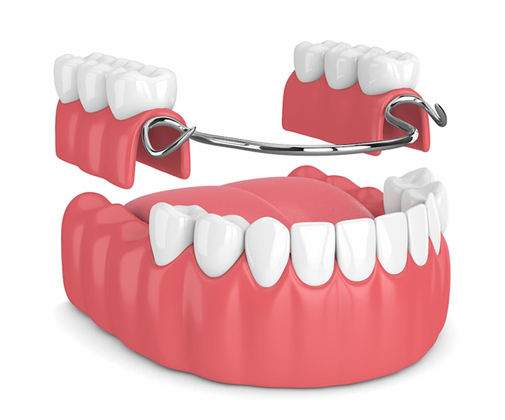 Dentures image Dentures