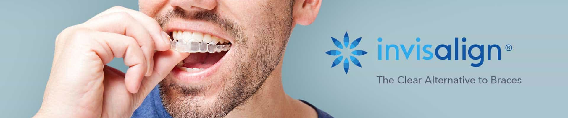 invisalign Invisalign Braces
