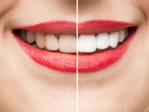 Teeth Whitening 2 Hornsby Teeth Whitening