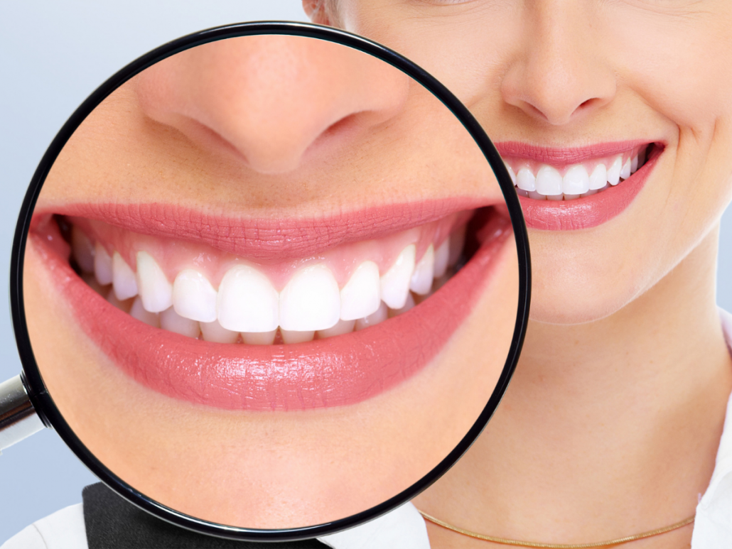 Teeth Whitening 3 Teeth Whitening in Hornsby