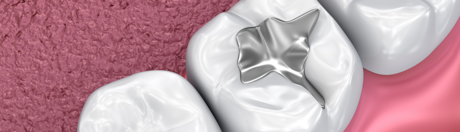 Dental Filling Filling Hornsby dentist