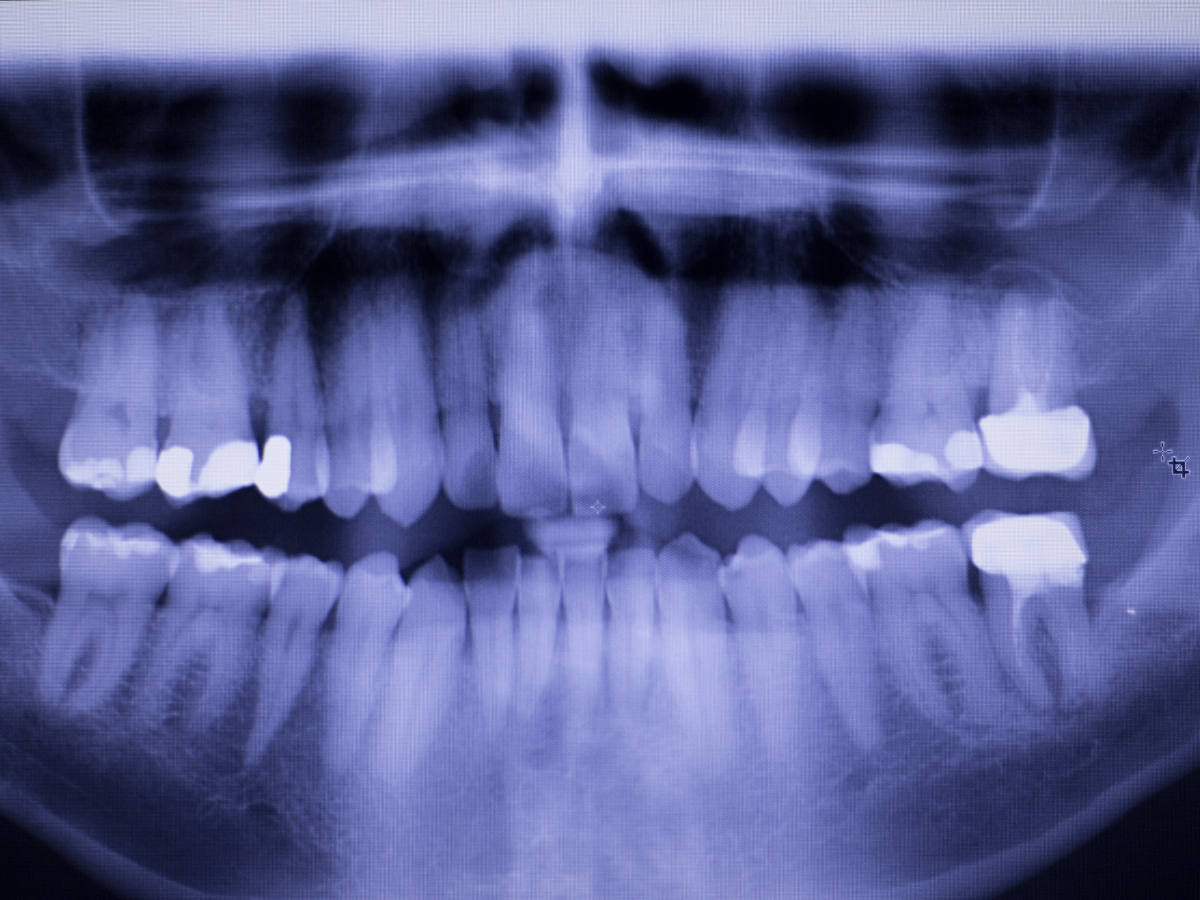 Dentist fillings xray Tooth in pain, Hornsby