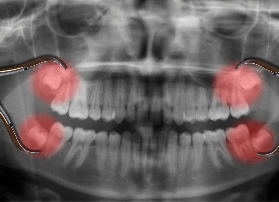 Untitled design (75) Removal of wisdom teeth in Hornsby