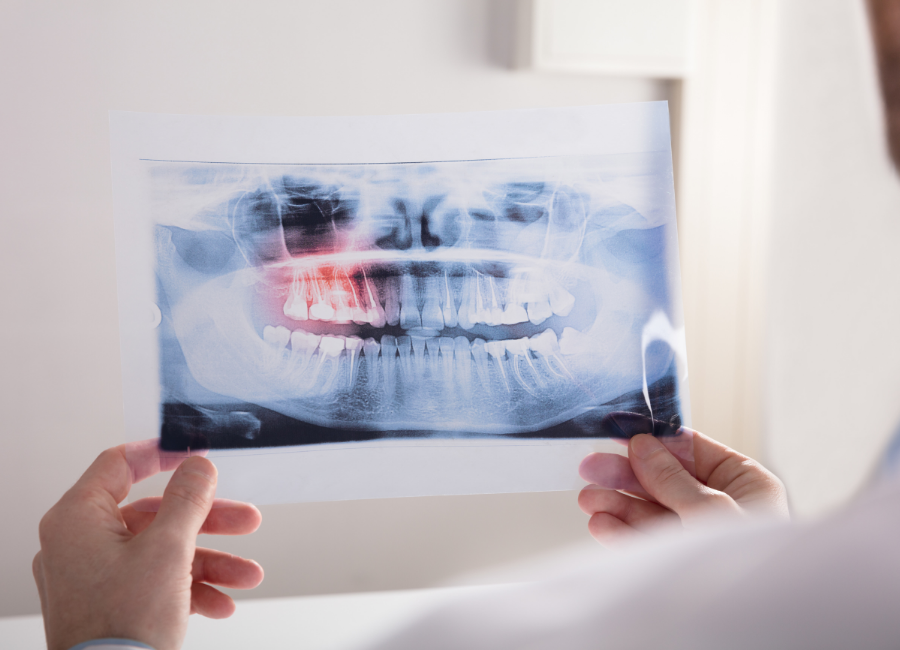 Untitled design (78) Wisdom teeth Hornsby