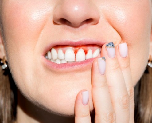 Hornsby bleeding gums