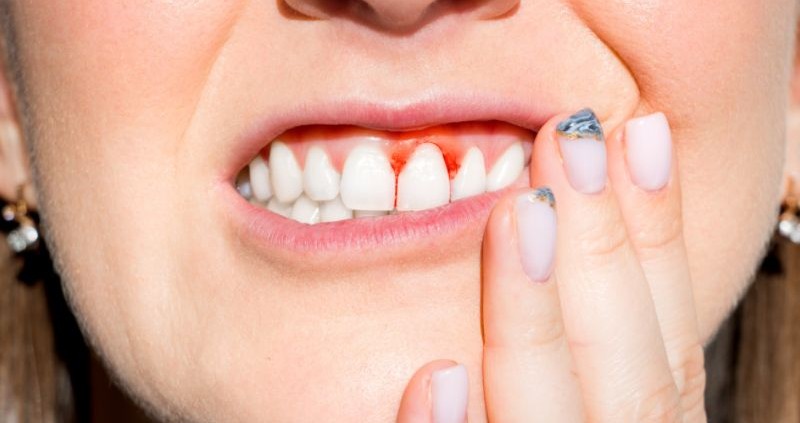 Hornsby bleeding gums