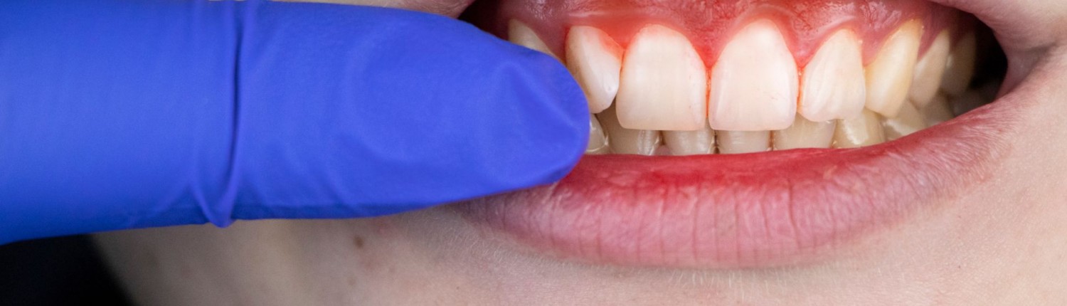 Bleeding gums dentist Hornsby