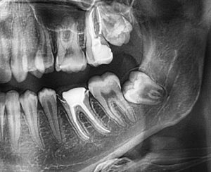 1-min wisdom teeth problems