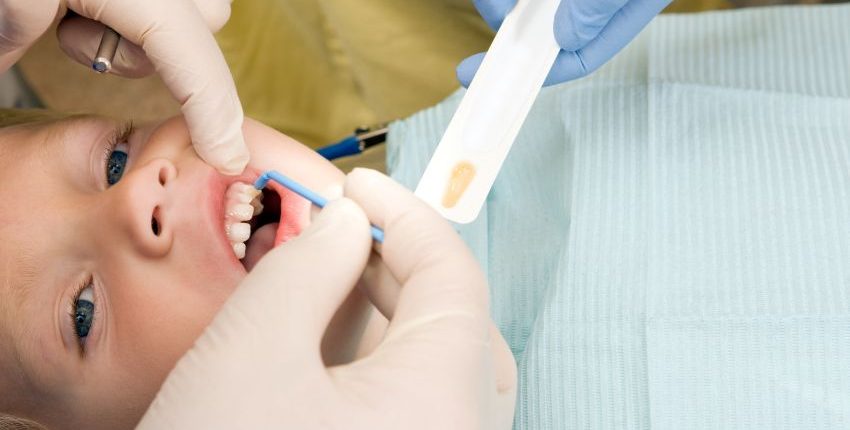 Fluoride Treatment for child-min